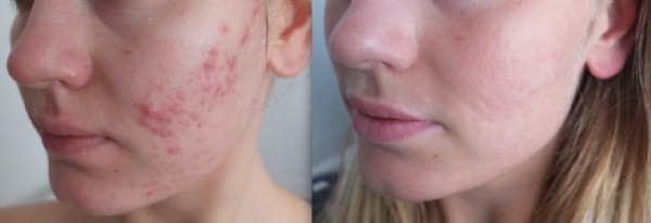 Roaccutane Nedir? Roaccutane Nasıl Kullanılır? Roaccutane Kullananların Yorumları Nelerdir?